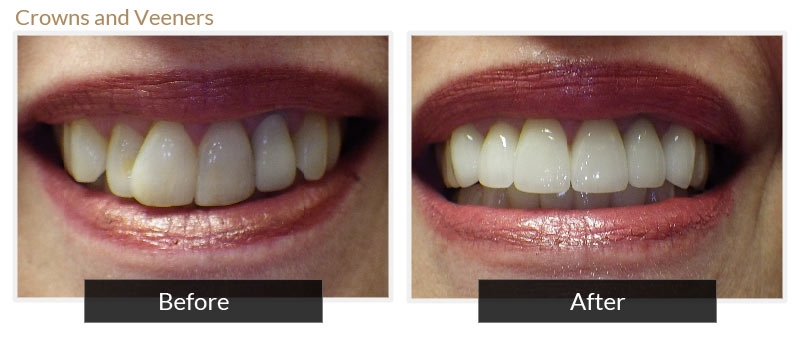 zoom teeth whitening reviews 2015