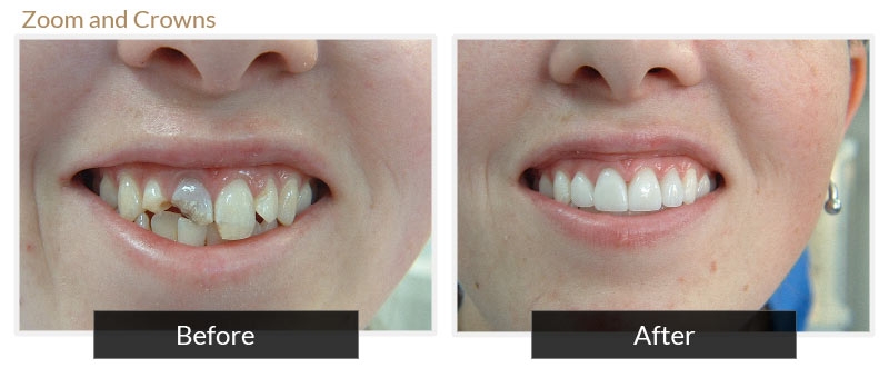 zoom teeth whitening reviews 2015